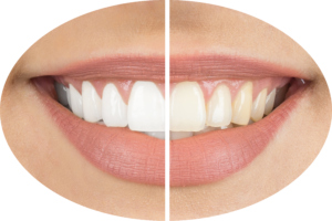 Teeth Whitening